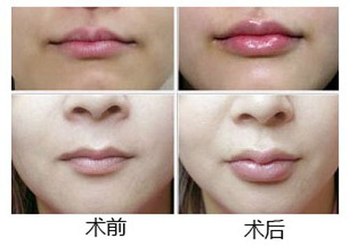 玻尿酸丰唇大概多少钱