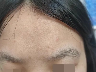 痤疮前额丘疹图片