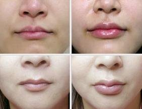 玻尿酸丰唇多少钱一针