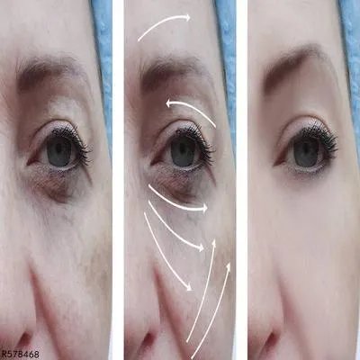 脸上皮肤松弛下垂怎么办