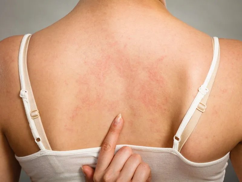 身上有小血点是什么原因