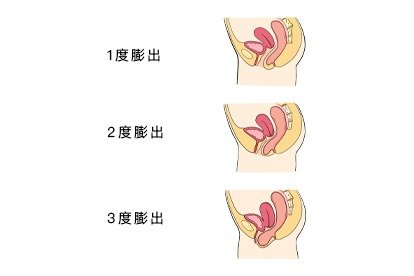 阴壁膨出1度2度3度图片真实