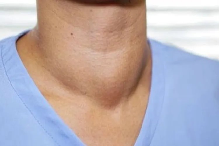 甲状腺喉结肿大图片