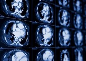 广州医学院第三附属医院引进超声自动乳腺全容积成像系统