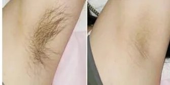 激光脱腋毛怎么做