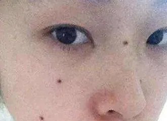 点痣多少钱一颗