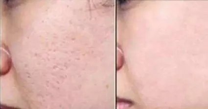 去痘疤哪家美容院好