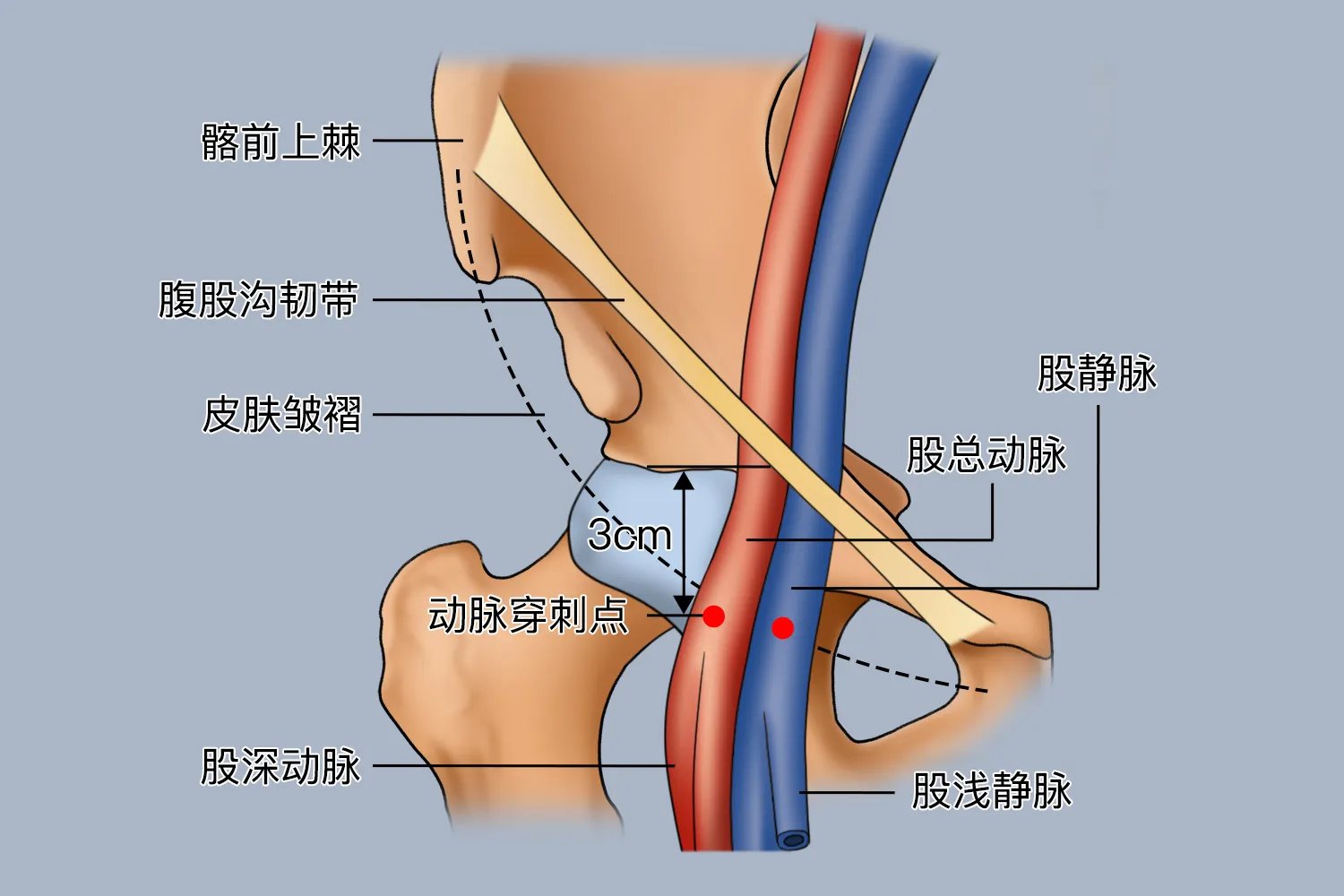 股动脉穿刺技巧图解