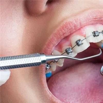 拔了智齿要注意什么