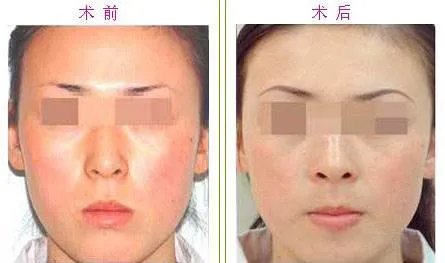 彩光嫩肤效果好吗