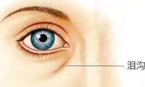 泪沟填充术多少钱
