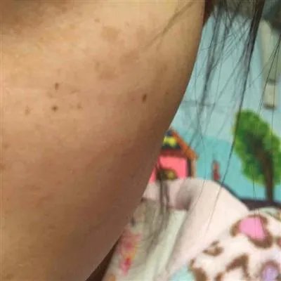 如何去斑的方法