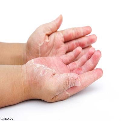 手脱皮怎么快速治疗