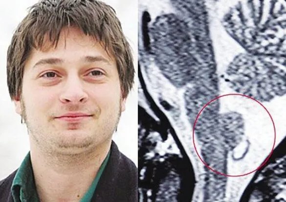 世界上打嗝时间最长的人,美国农夫打嗝长达68年（每天打嗝24000次）