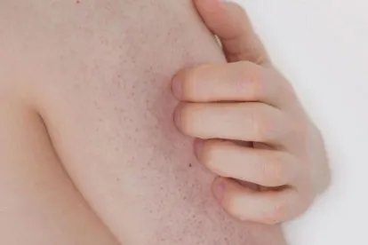 毛孔角化症痒图片