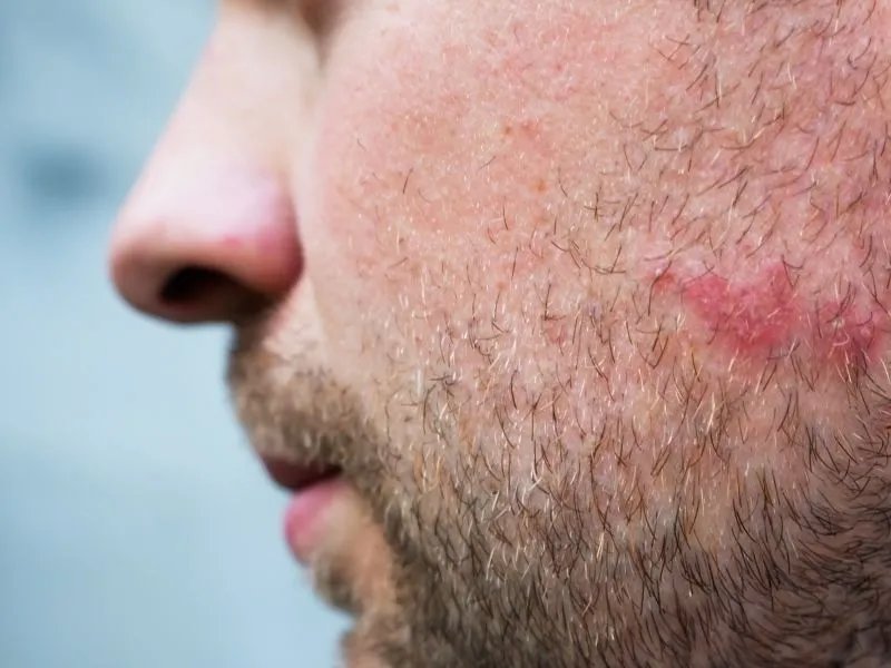 长疥疮了怎么办