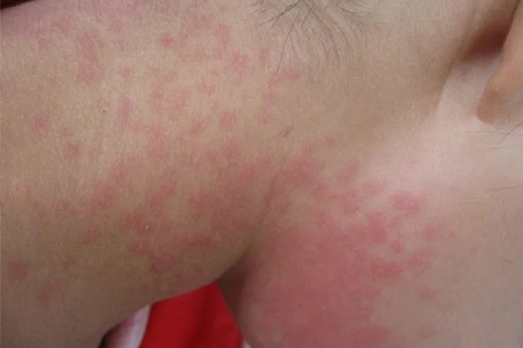 螨虫过敏皮肤症状图片