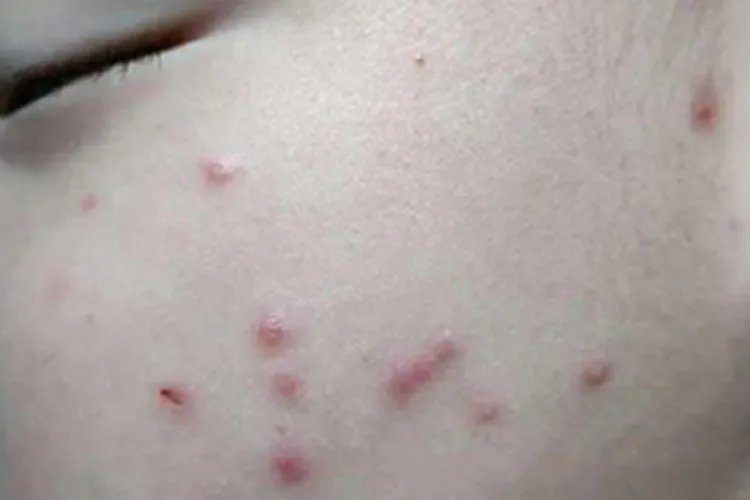 儿童湿疹的症状和图片