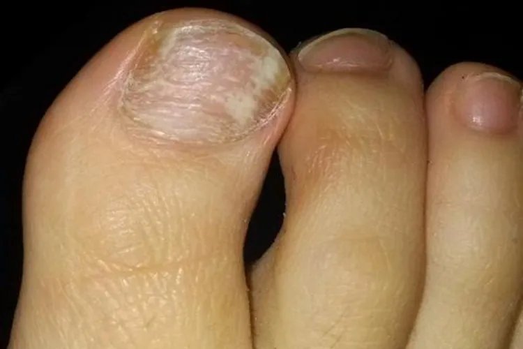 脚趾甲横纹断层图片