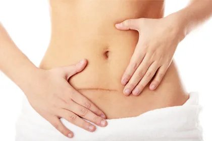 如何去除手术疤痕