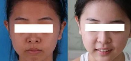 彩光嫩肤手术价格是多少