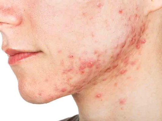 痤疮的常见病因有哪些