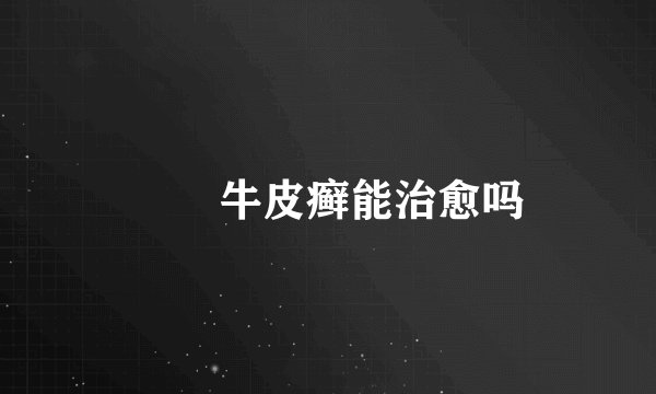 　　牛皮癣能治愈吗