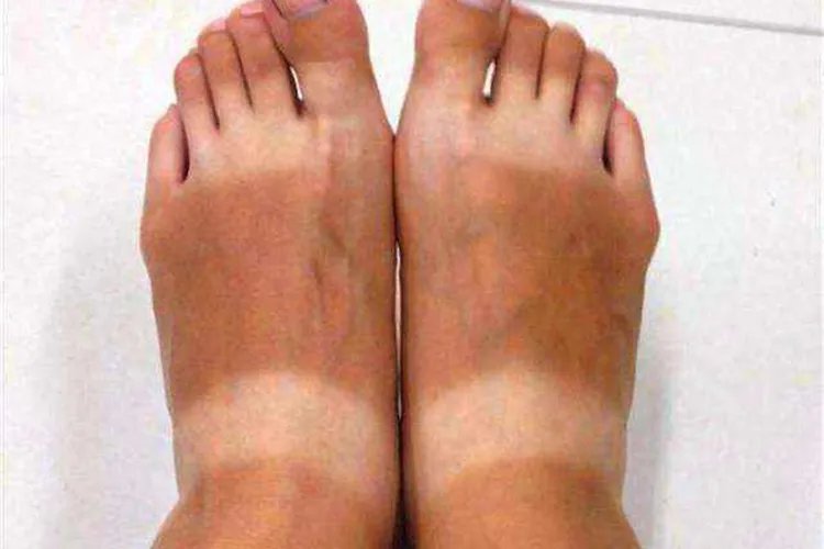 脚上有黑色素沉着图