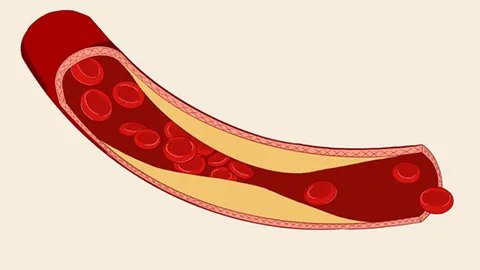 血管硬化可以吃什么