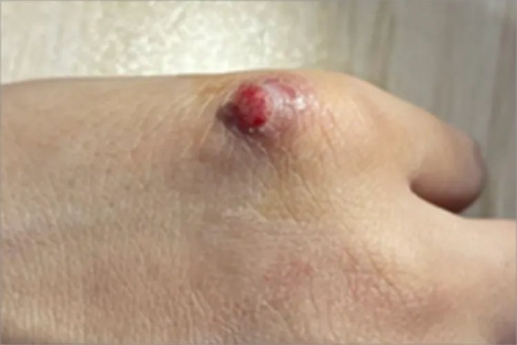 血管瘤手背小红疙瘩图片