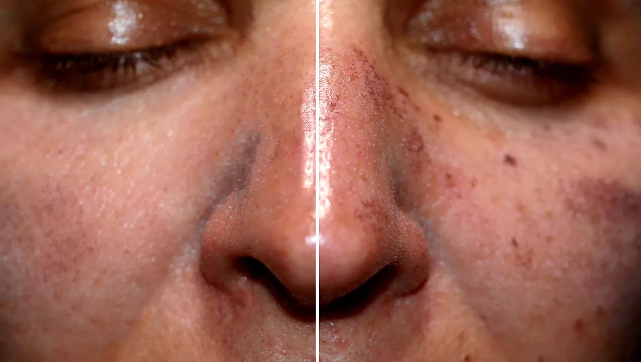 怎么去除老年斑