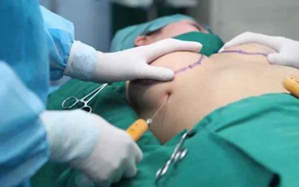 妙桃隆胸要多少钱