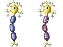 2型糖尿病性周围神经病变