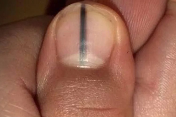 得癌症人的指甲图片