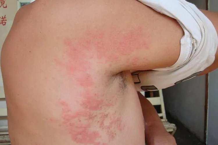 螨虫过敏皮肤症状图片