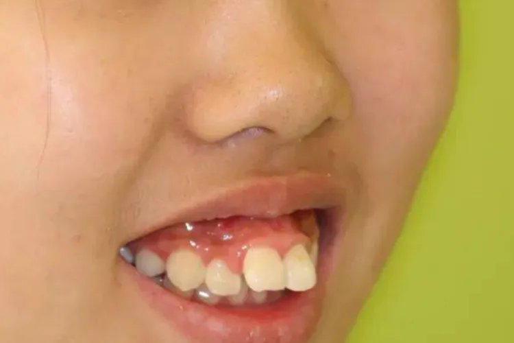 小孩长龅牙图片