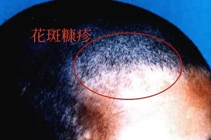 头皮汗癣的图片