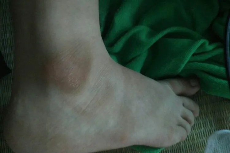 脚上有黑色素沉着图