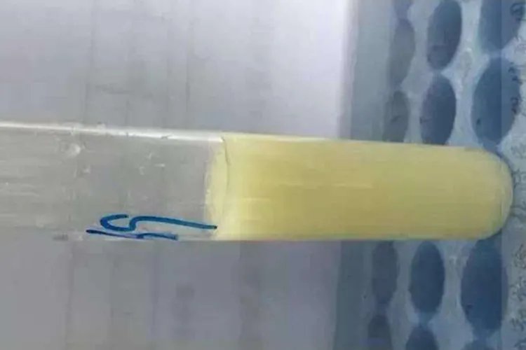 小便图片对比图