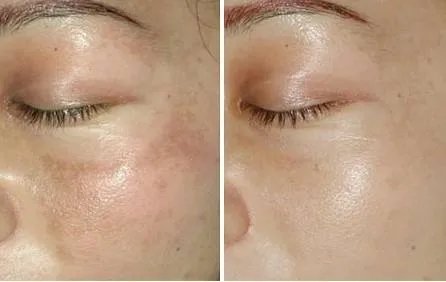 opt祛斑效果好不好