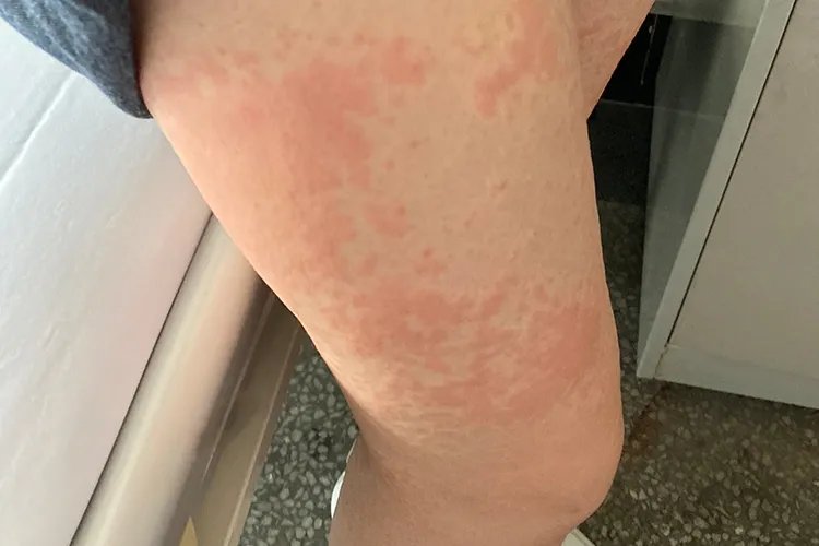 螨虫过敏皮肤症状图片