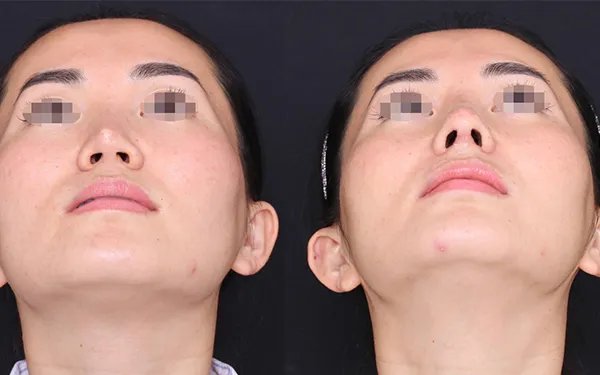 北京鼻翼缩小价格是多少