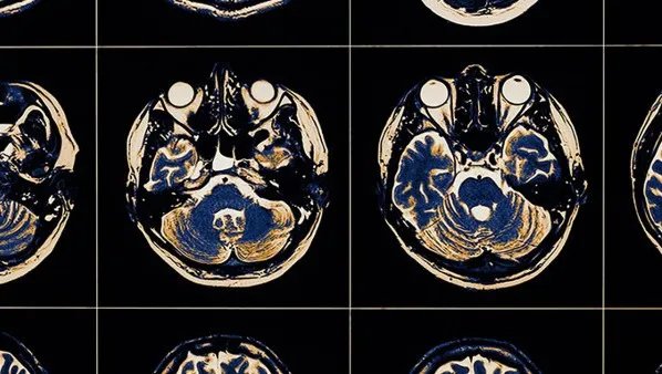 脑血栓吃什么好