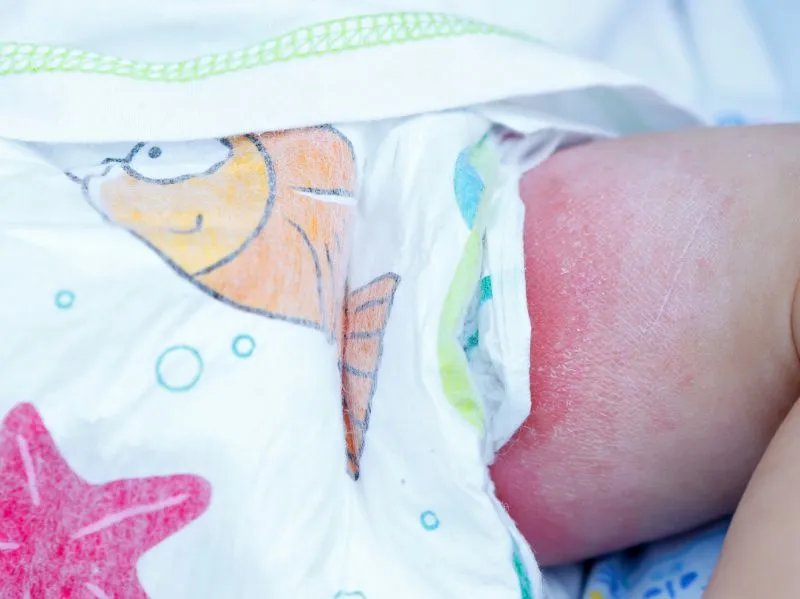 尿道口发痒的原因