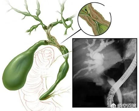 《金粉世家》的导演李大为因罹患胆管细胞癌去世，这种癌症很难治吗？