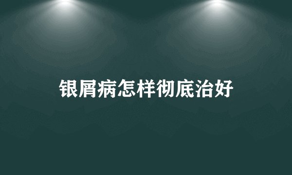 银屑病怎样彻底治好