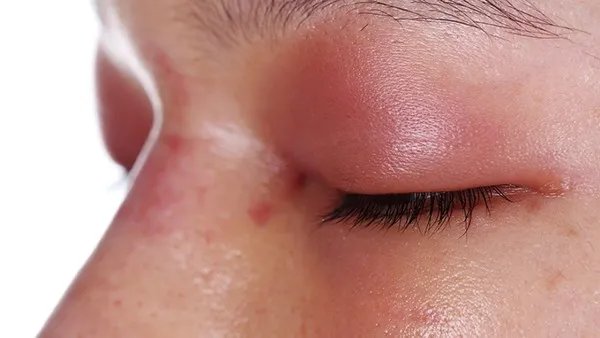 注射美白针的注意事项和禁忌