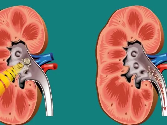 尿结石是怎么形成的