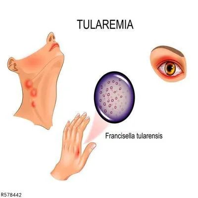得了聚合性痤疮怎么办
