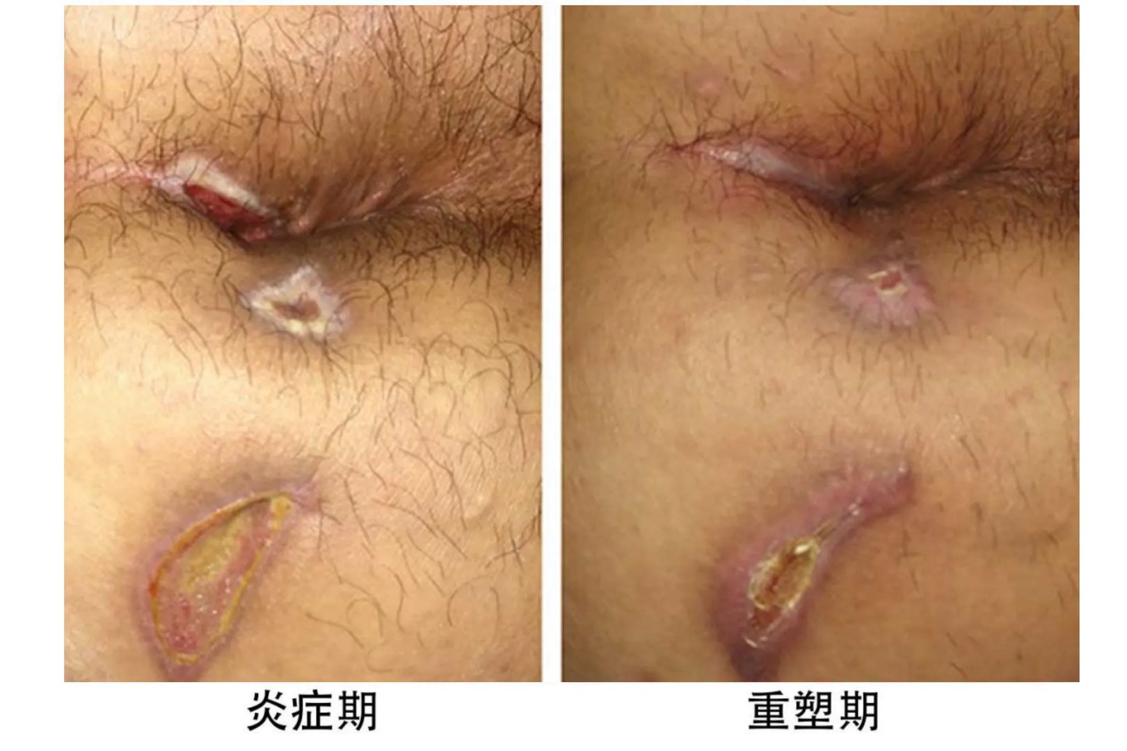 肛瘘手术伤口愈合过程图解